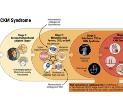 The stages of cardiovascular-kidney-metabolic syndrome that was included in the new ACC-AHA CKM syndrome guideline.