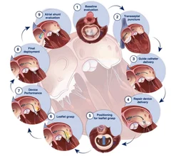 ASE guidelines summary of recommended imaging steps for performance of M-TEER.