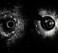 An example of the Novasight Hybrid System, showing its co-registered IVUS (left) and OCT intravascular imaging inside a coronary stent.