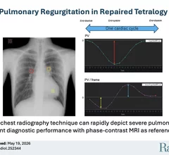 DDR dynamic cardiac X-ray for pulmonary valve regurgitation evaluation. Figure courtesy of RSNA