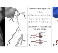 A figure from the new SCCT FFR-CT consensus document to help explain how the technology works to assess hemodynamic flow using CT imaging.