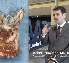 Robert Hawkins, MD, MSC, assistant professor of cardiac surgery, University of Michigan, discusses the growing trends of surgical aortic valve replacement (SAVR) following prior transcatheter aortic valve replacement (TAVR) and how to best risk assess these patients using a new STS risk calculator.