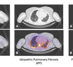 SPECT agent differentiates between active inflammation and fibrosis in lung disease