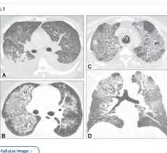 What hantavirus looks like on imaging