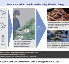 This novel vibration-based extraction technique exhibited excellent safety and efficiency profiles in preclinical and initial human study, potentially offering a simple, rapid, and safe alternative to conventional extraction methods
