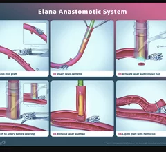 Distal anastomoses are almost exclusively hand-sewn as a current standard of care, which limits the widespread implementation of less-invasive approaches. This trial looked at the ability of the ELANA device to more easily construct distal anastomoses in CABG.