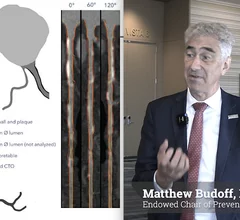 Matthew Budoff, MD, FACC, FAHA, FSCCT, a professor of medicine at David Geffen School of Medicine at UCLA and the Endowed Chair of Preventive Cardiology at Harbor-UCLA Medical Center, and former SCCT president, explains how new CCTA technologies will change cardiac preventive care.