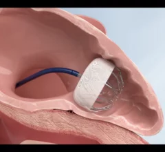 AnchorMan LAAC device MicroPort CardioFlow