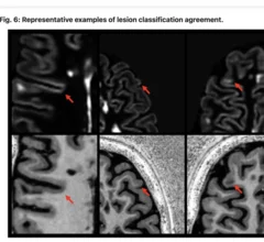 AI helps spot invisible gray matter MS lesions