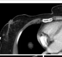 Most visible breast lesions are missed on chest CT scans