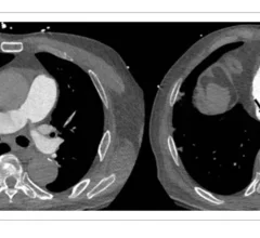 ACR rolls out PE-RADS--new reporting framework for pulmonary embolism