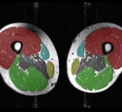 Weight fluctuations cause muscle loss