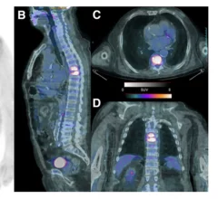 PET/CT excels at determining source of fever of unknown origin