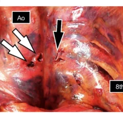 Rib fracture turns deadly after puncturing aorta