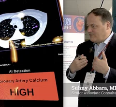Suhny Abbara, MD, FACR, MSCCT, FNASCI, senior associate consultant and professor of radiology, Mayo Clinic, Jacksonville, Florida, and editor of the RSNA journal Radiology, gave high praises to opportunistic AI screenings for coronary calcium at SCCT 2026. He said there are more than 20 million chest CTs performed each year in the U.S., which holds a massive promise to detect millions of new patients with asymptomatic coronary artery disease that the patient is unaware of. #SCCT #YesCCT #Radiology