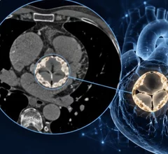 Aortic stenosis opportunistic CT AI imaging from SCCT 2026 presentation by Ofir Koren, MD, Cedards-Sinai.