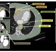 Caristo's FAI imaging AI is FDA-cleared for the detection of inflammation in cocornary arteries, but resrach is also looking at its use in detecting the cause of AFib and heart failure. Image courtesy of the European Heart Journal