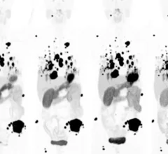 Theranostic pair shines at diagnosing and treating kidney cancer