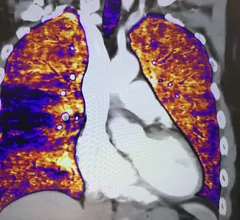Deep learning spectral pulmonary embolism (PE) imaging displayed by Canon CT at RSNA.