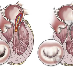 An illustration showing how the Mitria Medical Subvalvular Spacer (SVS) helps repair remodeling of the heart that distorts the valve and prevents proper leaflet closure due to functional mitral regurgitation (FMR). Structural Heart, April 2022, https://www.structuralheartjournal.org/article/S2474-8706(22)01273-8/fulltext.