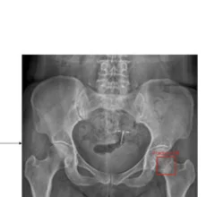 AI spots difficult-to-detect femoral neck fractures