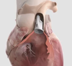 The Autus pulmonary heart valve is adjustable so it can grow with congenital heart patients as they age.