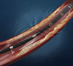 Intravascular lithotripsy (IVL) therapy to break up calcified coronary lesions will now be reimbursed at a higher rate under new in-hospital codes the went into effect Oct. 1. Illustration of the Shockwave lithoplasty procedure using sonic waves to bust calcium without trauma.