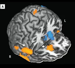 Functional MRI (fMRI) image measuring the strength of connectivity in particular brain circuits before and after subjects were given either a 20-milligram oral dose of methylphenidate used to treat ADHD or a placebo. The scans showed that methylphenidate strengthened connectivity between several brain regions involved in regulating emotions and exerting control over behaviors. Image courtesy of Brookhaven, Stony Brook, and the National Institutes of Health.