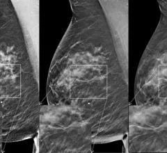 An example of architectural distortion in a 3D DBT mammogram, which is easier to see because the radiologist can look at the breast tissue layer-by-layer.