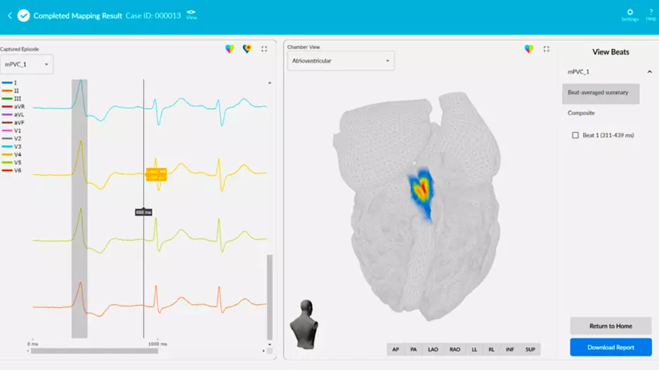 The Vektor Medical vMap system takes standard 12-lead ECGs and converts them into detailed electro anatomical maps for us in catheter ablation procedures.