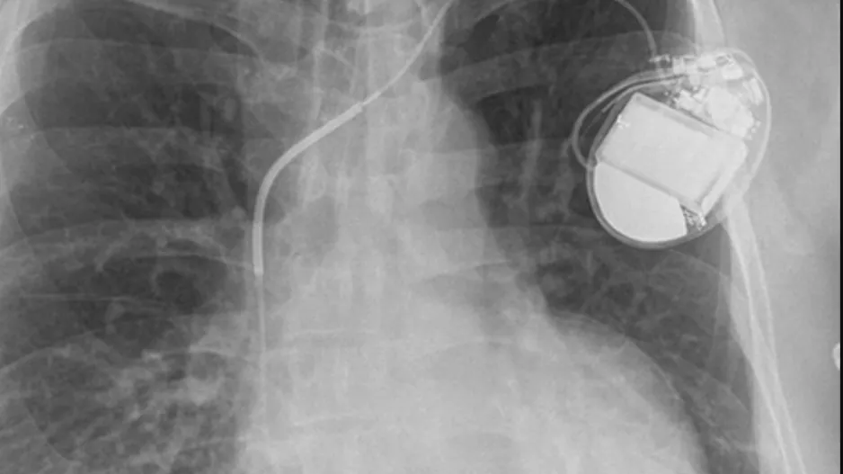 An implantable cardioverter defibrillator (ICD) and its associated leads viewed on a X-ray. Old leads are often abandon in veins and new ones added, but a new study of 1 million patients at ACC22 showed there is higher mortality if a device becomes infected and the leads are left behind. Image from RSNA.