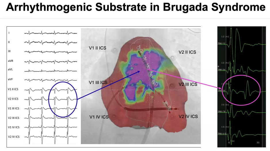 Brugada arrhythmogenic substrate that causes VT and sudden cardiac death. This study showed ablation of this substrate area could help prevent sudden cardiac arrest in these patients.