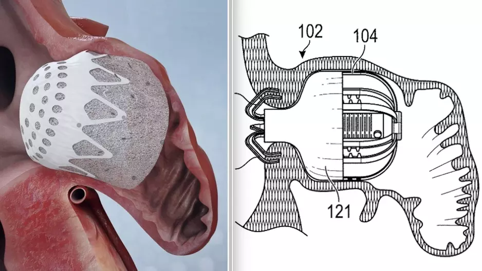 Two examples of new left atrial appendage occluders (LAAO), the Conformal omn left and the Laminar on the right. evi Nair, MD, FACC, FHRS, director of cardiac electrophysiology at St. Bernard's Healthcare, Jonesboro, Arkansas, explains some of the recent advances in transcatheter left atrial appendage (LAA) occlusion technology at the 2022 Transcatheter Valve Therapeutics (TVT) Structural Heart Summit. #TVT #TVT2020 #LAA #LAAO #EPeeps