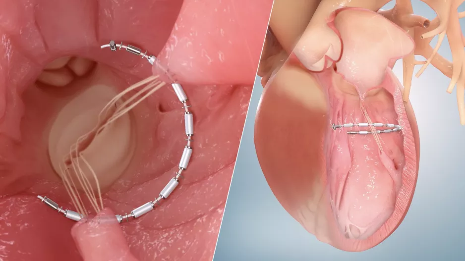 Ancora Heart AccuCinch Ventricular Restoration System heart failure FDA 