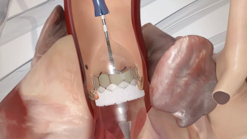 Balloon expansion deployment of an Edwards Lifesciences Sapien 3 transcatheter aortic valve replacement (TAVR) device.