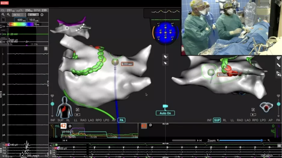 Affera Inc Medtronic $925 million catheter ablation atrial fibrillation (AFib)