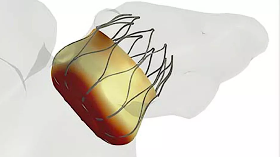 A FEOPS image of a Watchman LAA occluder device being checked for virtual sizing in an anatomical model of the patient's left atrial appendage. Dhanunjaya Lakkireddy, MD, explains the role and technology of LAA closure devices in managing AFib patients. 