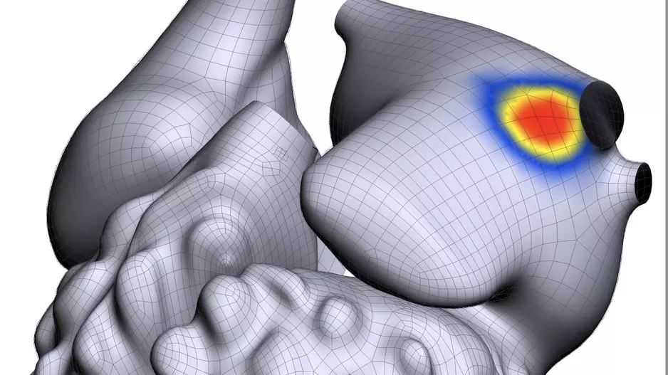 Atrial Fibrillation and its location in the atrium detected using the Vektor arrhythmia detection software. COVID infection can cause the development of AFib, AF, in patients as a long-COVID symptom.