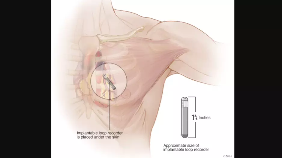 The increased use of implantable loop recorders (ILRs) is associated with identifying more bradyarrhythmias such as bradycardia, according to new findings published in JAMA Cardiology.