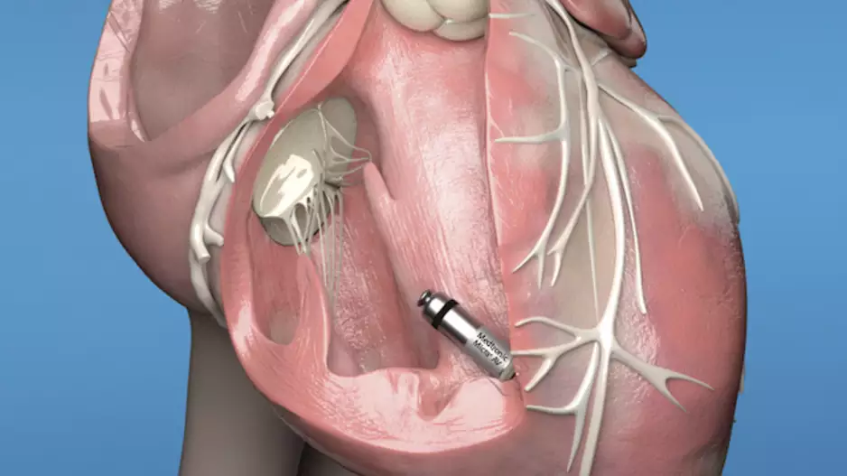 The Medtronic Micra leadless pacemaker implanted inside the heart. It is about the size of a large vitamin pill and is implanted using a catheter.