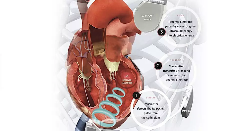 The EBR Systems WiSE leadless cardiac resynchronization therapy (CRT) system. #HRS23