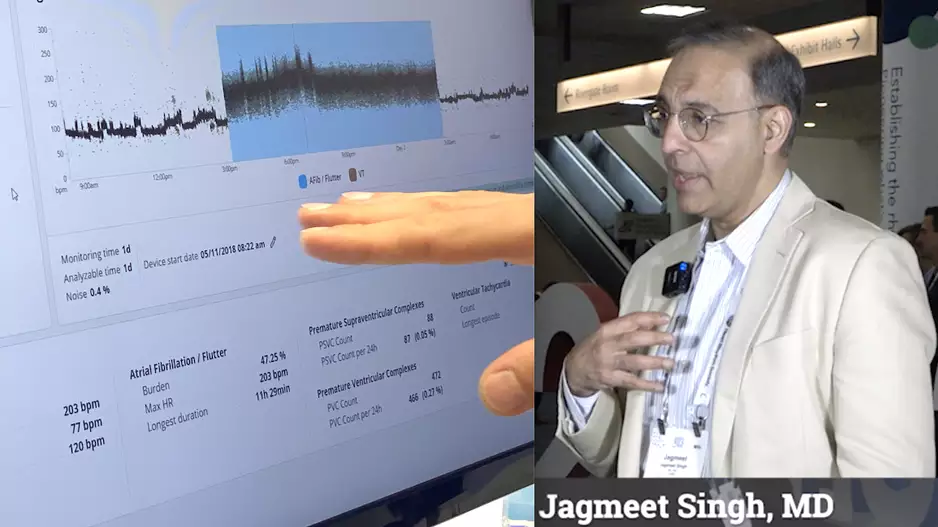 The proliferation of artificial intelligence (AI) in healthcare includes numerous algorithms for electrophysiology (EP). Jagmeet Singh, MD, Professor of Medicine, Harvard Medical School, and founding director of the Resynchronization and Advanced Cardiac Therapeutics Program and Mass General Hospital, spoke with Cardiovascular Business at Heart Rhythm 2023 to explain how AI is being used in EP. #HRS2023 #HRS #AI