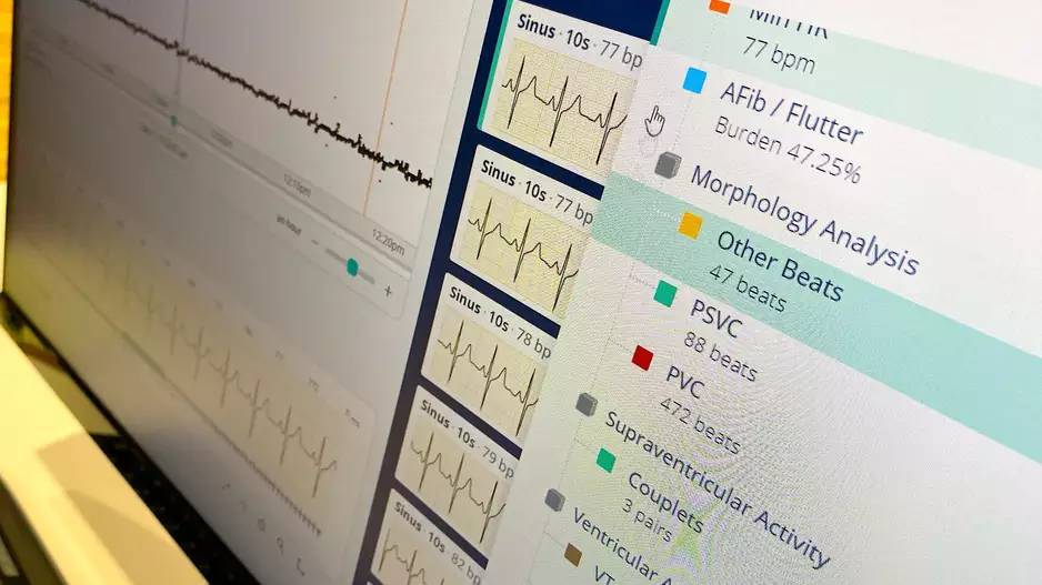 Artificial intelligence (AI) analysis from a remote ECG monitor showing the AI generated report on the Philips Cardiologs system, during a demonstration of the technology at Heart Rhythm 2023. Photo by Dave Fornell