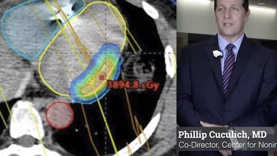 Phillip Cuculich MD explains Noninvasive Cardiac Radiotherapy ablation for ventricular tachycardia as a late-breaking study at HRS 2023. #HRS2023