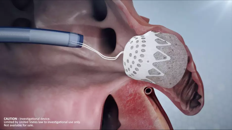 The CLAAS device from Conformal Medical