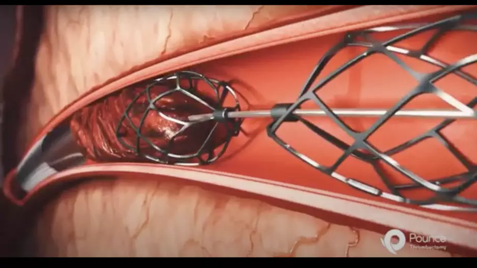 The Pounce Thrombectomy System by Surmodics. The company just gained FDA clearance on a new version of the system for smaller arteries. 