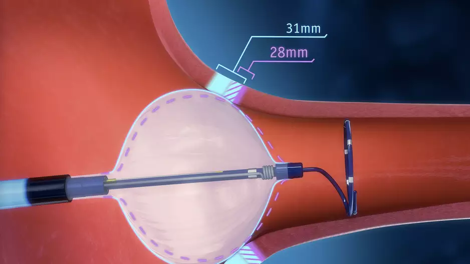 Boston Scientific’s POLARx Cryoablation System for atrial fibrillation gained FDA approval in August 2023. 