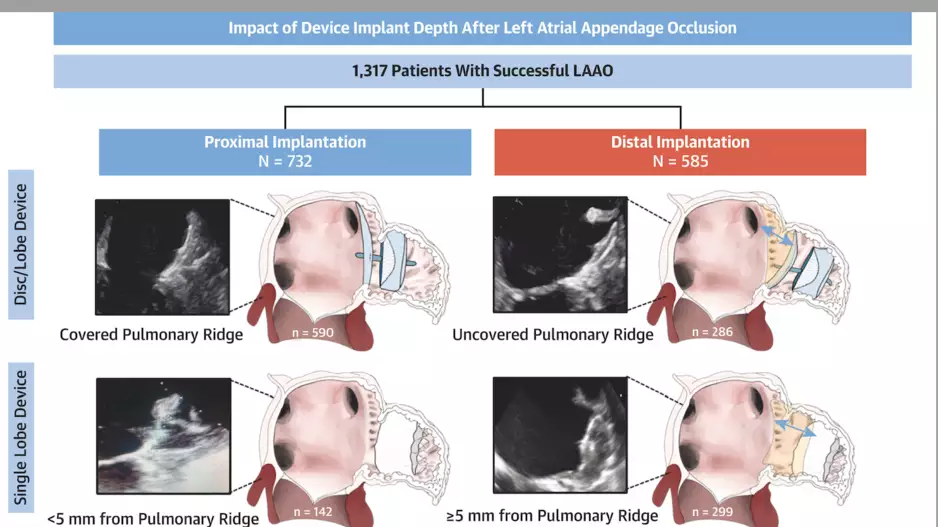 The depth of left atrial appendage occlusion (LAAO) devices inside the LAA impacts outcomes. #LAAO