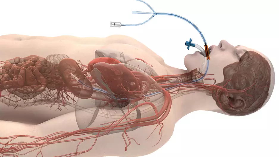 Attune Medical has been granted De Novo marketing authorization from the US Food and Drug Administration (FDA) for its ensoETM device to reduce the likelihood of ablation-related esophageal injury resulting from radiofrequency cardiac ablation procedures.