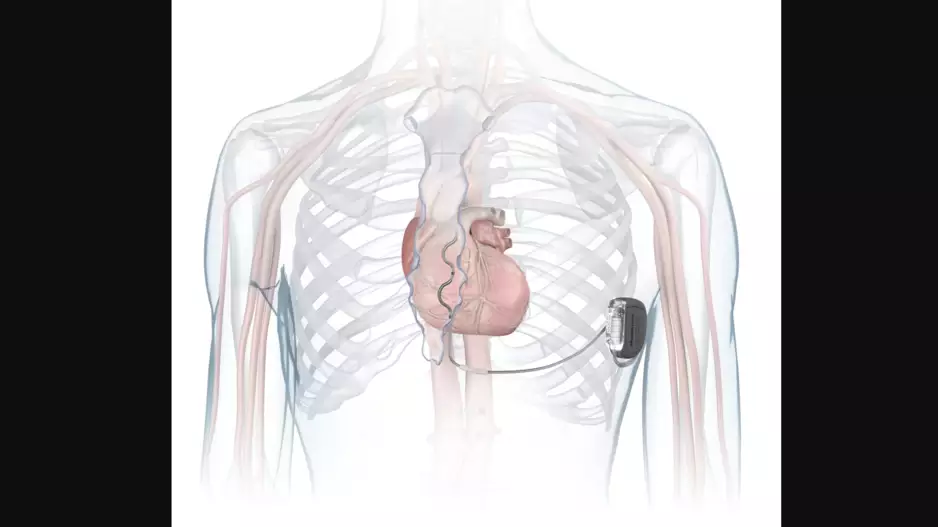 Medtronic extravascular ICD Aurora EV-ICD MRI SureScan